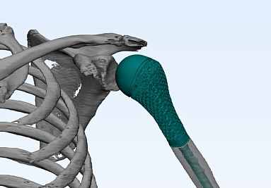 На российском рынке появился печатный имплантат плечевого сустава с модифицированной поверхностью